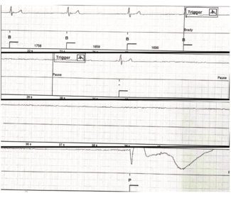 Doshi Pacemaker Figure 1