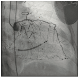 Gogo Angioplasty Figure 