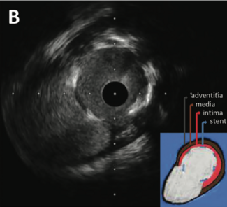 Guerrero Intracoronary Imaging TN