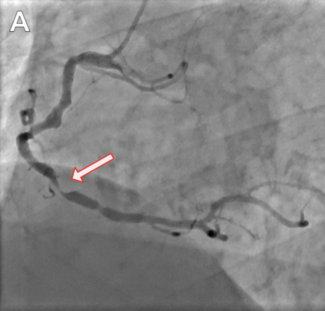 Kaier GooseNeck Snare TN