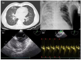 Karelas Pulmonary Edema Figure 1