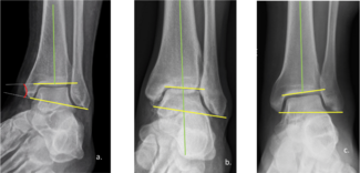 Ankle Deformities in Athletes: Looking Beyond Arthritis | Podiatry Today