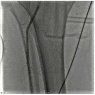 Pratsos Serranator TN