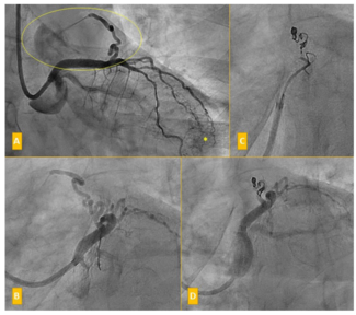 Sanchez Artery Fistula Figure 1