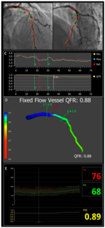Santos Quantitative Flow Ratio Figure 1