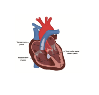 Tale Tetralogy of Fallot TN