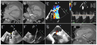 Agasthi Stent Figure 1