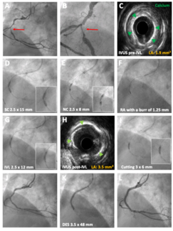 Cubero-Gallego Lithotripsy Figure 1