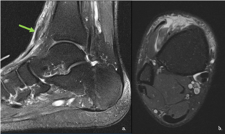 Getting Patients Back to Activity Following Tibialis Anterior Tendon Rupture