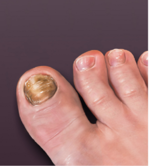 Proposing an Algorithm to Treat Dystrophic Toenails