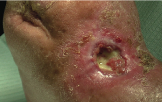 What is the Future Potential of Percutaneous Deep Vein Arterialization for No-Option Chronic Critical Limb-Threatening Ischemia?