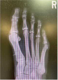 One Surgeon’s Experience With a Unique Bunion Fixation Option
