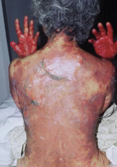 patient with a history of severe allergy to sulfa drugs