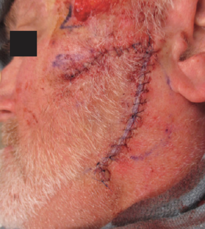 closure of rotation flap