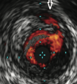 Secemsky Figure 1 CLD August 2022
