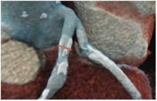 Siemens Calcification 