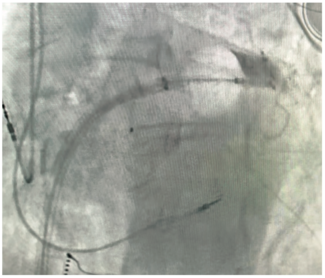 Venkataraman Cryoballoon Figure 1