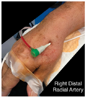 CLD Casazza Right Distal Radial Artery Access