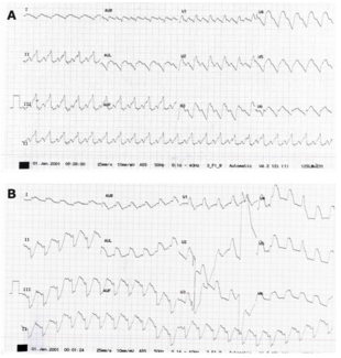 Kanjanarutjawiwat STEMI Figure 1