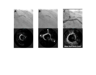 Khatri Calcified Vessels Figure 1