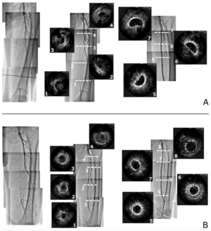 Sakamoto Chronic Total Occlusion Figure 3