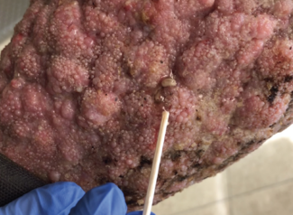 Multiple, oozing nodules and organisms on the patient’s right leg.