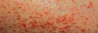 atopic dermatitis (AD) Rash