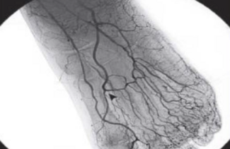 Angiographic view of the anterior pedal arch vessels. 