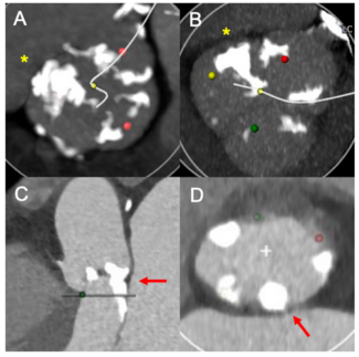Kim Transcatheter Figure 1