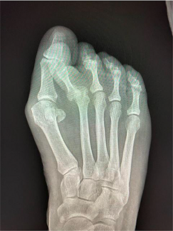 Is MIS a Viable Alternative to the Lapidus for Larger Bunions? 