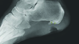 Comparing Medical vs. Surgical Management of Osteomyelitis in the Diabetic Foot