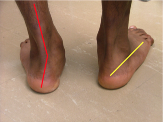 Treating Deformities in Athletes: Pes Cavus and Pes Planus