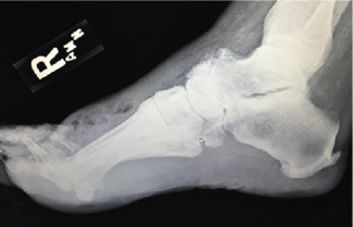 The Modified Boyd Fusion: An Uncommon Limb Salvage Procedure 