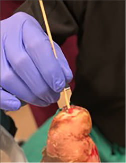 A Guide to Diagnostic Techniques for DFU Soft Tissue Infection and Osteomyelitis