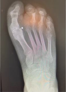 Improving Surgical Outcomes in the Management of Diabetic Foot Disease