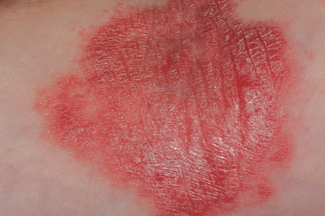 Psoriasis rash