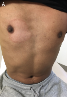 Hypopigmentation on the Trunk