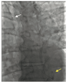 Terumo Rufus Peripheral Procedures Figure 3