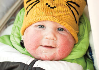 baby eczema