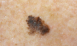 melanoma