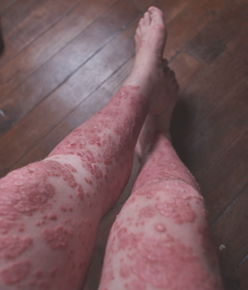 psoriasis severe