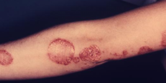 Psoriasis