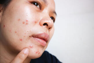 Acne