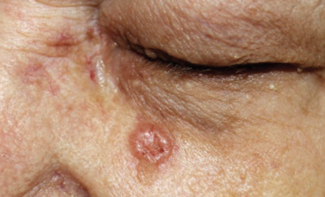basal cell carcinoma