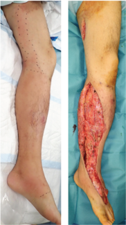 Figure 1. A 47-year-old man with GAS-NSTI, samples number 24 and 55