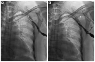 Bhasin Pacemaker Figure 1