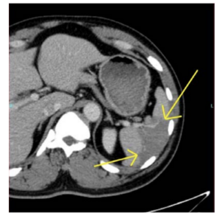 Figure 4.  Arrows showing a wedged splenic hypodensity suggesting splenic infarction.