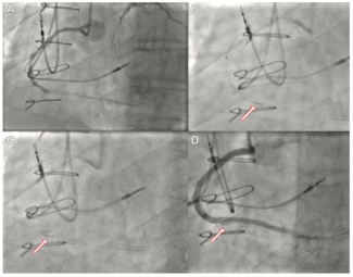 Kaier Antegrade Dissection Figure 1