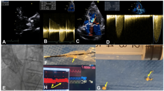 Kalogeropoulos Off-Label TAVR Figure 1