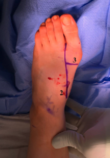 Siddiqui’s Tips, Tricks, and Pearls for Minimally Invasive Bunionectomy